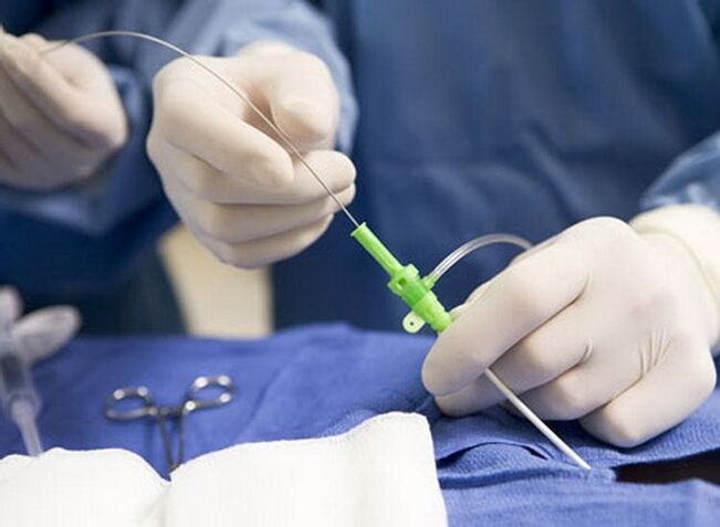 Irrati-frekuentziazko ablazioa