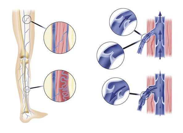Balbula venous ezgaiak barizeak ekartzen ditu